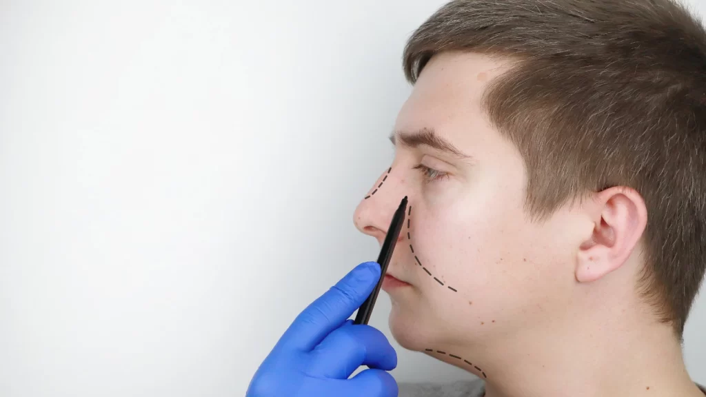 Erkeklerde Burun Estetiği