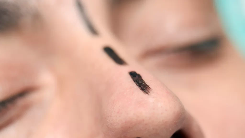 Burun estetiği ankara